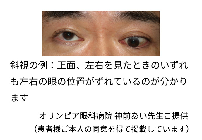左右の眼の位置がずれる(斜視)