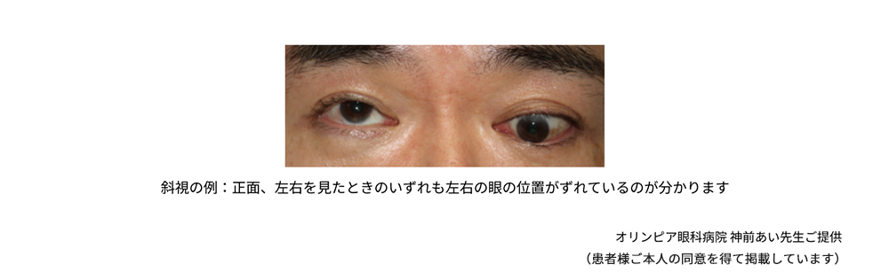 左右の眼の位置がずれる(斜視)