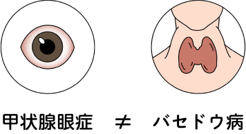 甲状腺眼症≠バセドウ病